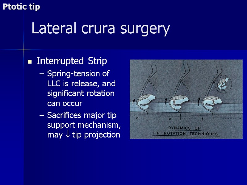 Interrupted Strip Spring-tension of LLC is release, and significant rotation can occur Sacrifices major